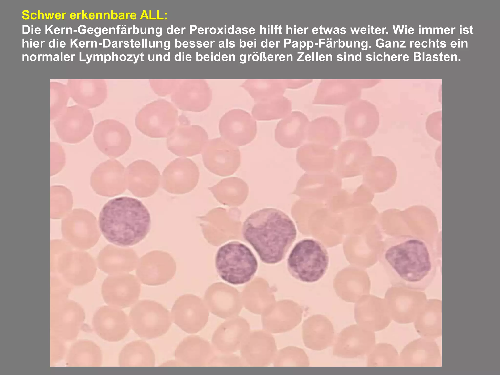 Akute Lymphatische Leukämie Kernschatten – UPAPGU