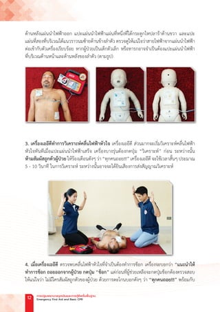 ด้านหลังแผ่นน�ำไฟฟ้าออก แปะแผ่นน�ำไฟฟ้าแผ่นที่หนึ่งที่ใต้กระดูกไหปลาร้าด้านขวา และแปะ
แผ่นที่สองที่บริเวณใต้แนวราวนมซ้ายด้านข้างล�ำตัว ตรวจดูให้แน่ใจว่าสายไฟฟ้าจากแผ่นน�ำไฟฟ้า
ต่อเข้ากับตัวเครื่องเรียบร้อย หากผู้ป่วยเป็นเด็กตัวเล็ก หรือทารกอาจจ�ำเป็นต้องแปะแผ่นน�ำไฟฟ้า
ที่บริเวณด้านหน้าและด้านหลังของล�ำตัว (ตามรูป)
3. เครื่องเออีดีท�ำการวิเคราะห์คลื่นไฟฟ้าหัวใจ เครื่องเออีดี ส่วนมากจะเริ่มวิเคราะห์คลื่นไฟฟ้า
หัวใจทันทีเมื่อแปะแผ่นน�ำไฟฟ้าเสร็จ เครื่องบางรุ่นต้องกดปุ่ม “วิเคราะห์” ก่อน ระหว่างนั้น
ห้ามสัมผัสถูกตัวผู้ป่วย ให้ร้องเตือนดังๆ ว่า “ทุกคนถอย!!!” เครื่องเออีดี จะใช้เวลาสั้นๆ ประมาณ
5 - 10 วินาที ในการวิเคราะห์ ระหว่างนั้นอาจจะได้ยินเสียงการส่งสัญญาณวิเคราะห์
4. เมื่อเครื่องเออีดี ตรวจพบคลื่นไฟฟ้าหัวใจที่จ�ำเป็นต้องท�ำการช็อก เครื่องจะบอกว่า “แนะน�ำให้
ท�ำการช็อก ถอยออกจากผู้ป่วย กดปุ่ม “ช็อก” แต่ก่อนที่ผู้ช่วยเหลือจะกดปุ่มช็อกต้องตรวจสอบ
ให้แน่ใจว่า ไม่มีใครสัมผัสถูกตัวของผู้ป่วย ด้วยการตะโกนบอกดังๆ ว่า “ทุกคนถอย!!!” พร้อมกับ
การปฐมพยาบาลฉุกเฉินและการกู้ชีพขั้นพื้นฐาน
Emergency First Aid and Basic CPR
12
 