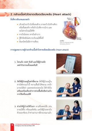 2. กล้ามเนื้อหัวใจขาดเลือดเฉียบพลัน (Heart attack)
สิ่งที่ควรสังเกตและจดจ�ำ
l เจ็บหน้าอกร้าวไปที่แขนซ้าย อาจจะร้าวไปข้างเดียว
หรือทั้งสองข้าง หรือร้าวไปที่ขากรรไกร และ
จะไม่หายไปแม้ได้พัก
l หายใจไม่ออก หายใจล�ำบาก
l รู้สึกอึดอัดไม่สบายบริเวณใต้ลิ้นปี่
l ล้มลงโดยไม่มีอาการเตือน
การปฐมพยาบาลผู้ป่วยกล้ามเนื้อหัวใจขาดเลือดเฉียบพลัน (Heart attack)
1. โทรแจ้ง 1669 ทันที และให้ผู้ป่วยพัก
		 งดท�ำกิจกรรมทั้งหมดทันที
2. จัดให้ผู้ป่วยอยู่ในท่าที่สบาย จัดให้ผู้ป่วยอยู่ใน
ท่านั่งพิงบนเก้าอี้ คลายเสื้อผ้าให้หลวม หาผ้า
มารองใต้เข่า และคอยช่วยปลอบใจ ให้ก�ำลังใจ
เตรียมพร้อมที่จะท�ำการช่วยฟื้นคืนชีพร่วมกับ
การใช้เครื่องเออีดี
3. ช่วยให้ผู้ป่วยได้รับยา ตามที่แพทย์สั่ง เช่น
ยาอมใต้ลิ้น หรือแอสไพริน และให้ผู้ป่วยหายใจ
ด้วยออกซิเจน ถ้าท่านผ่านการฝึกอบรมมาแล้ว
แหล่งที่มา
https://en.wikipedia.org/wiki/
Myocardial_infarction
การปฐมพยาบาลฉุกเฉินและการกู้ชีพขั้นพื้นฐาน
Emergency First Aid and Basic CPR
18
 