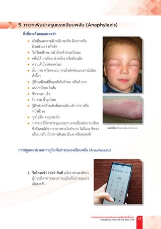 5. ภาวะแพ้อย่างรุนแรงเฉียบพลัน (Anaphylaxis)
สิ่งที่ควรสังเกตและจดจ�ำ
		l เกิดผื่นแดงตามผิวหนัง ลมพิษ มีอาการคัน
ผิวหนังแดง หรือซีด
		l วิงเวียนศีรษะ หน้ามืดคล้ายจะเป็นลม
		l คลื่นไส้ อาเจียน ปวดท้อง หรือท้องเสีย
		l ความดันโลหิตลดต�่ำลง
		l ลิ้น ปาก หรือคอบวม หายใจติดขัดและอาจมีเสียง
ดังวี๊ดๆ
		l รู้สึกเหมือนมีสิ่งอุดตันในล�ำคอ กลืนล�ำบาก
		l แน่นหน้าอก ใจสั่น
		l ชีพจรเบา เร็ว
		l ไอ จาม น�้ำมูกไหล
		l รู้สึกปวดคล้ายเข็มทิ่มตามมือ เท้า ปาก หรือ
หนังศีรษะ
		l พูดไม่ชัด ตะกุกตะกัก
		l บางรายที่มีอาการรุนแรงมาก อาจเสี่ยงต่อภาวะช็อก
ซึ่งสังเกตได้จากอาการหายใจล�ำบาก ไม่มีแรง ชีพจร
เต้นเบาเร็ว มีอาการสับสน มึนงง หรือหมดสติ
การปฐมพยาบาลภาวะภูมิแพ้อย่างรุนแรงเฉียบพลัน (Anaphylaxis)
		1. รีบโทรแจ้ง 1669 ทันที แจ้งว่าท่านสงสัยว่า
ผู้ป่วยมีอาการของภาวะภูมิแพ้อย่างรุนแรง
เฉียบพลัน
แหล่งที่มา Wikimedia Common
การปฐมพยาบาลฉุกเฉินและการกู้ชีพขั้นพื้นฐาน
Emergency First Aid and Basic CPR 23
 