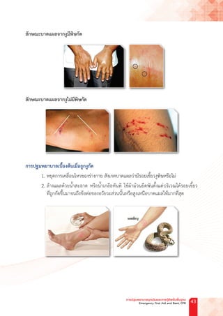 ลักษณะบาดแผลจากงูมีพิษกัด
ลักษณะบาดแผลจากงูไม่มีพิษกัด
การปฐมพยาบาลเบื้องต้นเมื่อถูกงูกัด
1. หยุดการเคลื่อนไหวของร่างกาย สังเกตบาดแผลว่ามีรอยเขี้ยวงูพิษหรือไม่
2. ล้างแผลด้วยน�้ำสะอาด หรือน�้ำเกลือทันที ใช้ผ้าม้วนยืดพันตั้งแต่บริเวณใต้รอยเขี้ยว
ที่ถูกกัดขึ้นมาจนถึงข้อต่อของอวัยวะส่วนนั้นหรือสูงเหนือบาดแผลให้มากที่สุด
การปฐมพยาบาลฉุกเฉินและการกู้ชีพขั้นพื้นฐาน
Emergency First Aid and Basic CPR 43
 