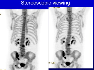 Stereoscopic viewing
 