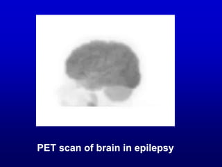 PET scan of brain in epilepsy
 
