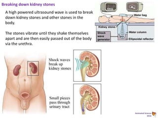Animated Science
2016
Breaking down kidney stones
A high powered ultrasound wave is used to break
down kidney stones and other stones in the
body.
The stones vibrate until they shake themselves
apart and are then easily passed out of the body
via the urethra.
 