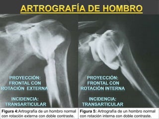 Figura 4:Artrografía de un hombro normal
con rotación externa con doble contraste.
Figura 5: Artrografía de un hombro normal
con rotación interna con doble contraste.
 