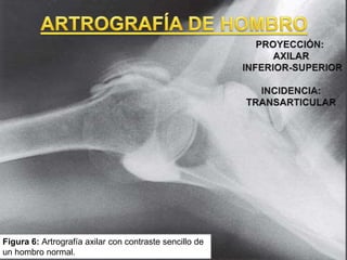 Figura 6: Artrografía axilar con contraste sencillo de
un hombro normal.
 