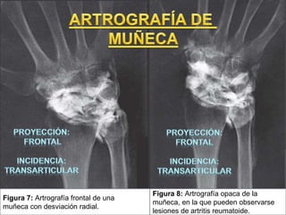 Figura 7: Artrografía frontal de una
muñeca con desviación radial.
Figura 8: Artrografía opaca de la
muñeca, en la que pueden observarse
lesiones de artritis reumatoide.
 