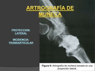 Figura 9: Artrografía de muñeca tomada en una
proyección lateral.
 