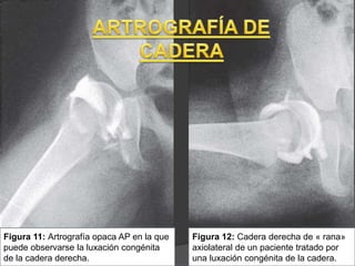 Figura 11: Artrografía opaca AP en la que
puede observarse la luxación congénita
de la cadera derecha.
Figura 12: Cadera derecha de « rana»
axiolateral de un paciente tratado por
una luxación congénita de la cadera.
 