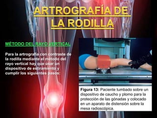 MÉTODO DEL RAYO VERTICAL
Para la artrografía con contraste de
la rodilla mediante el método del
rayo vertical hay que usar un
dispositivo de estiramiento y
cumplir los siguientes pasos:
Figura 13: Paciente tumbado sobre un
dispositivo de caucho y plomo para la
protección de las gónadas y colocado
en un aparato de distensión sobre la
mesa radioscópica.
 