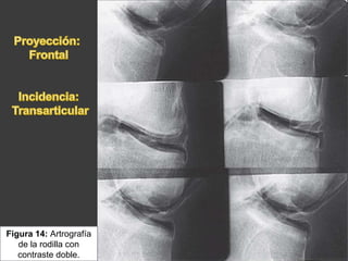 Figura 14: Artrografía
de la rodilla con
contraste doble.
 