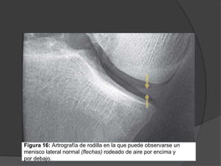 Figura 16: Artrografía de rodilla en la que puede observarse un
menisco lateral normal (flechas) rodeado de aire por encima y
por debajo.
 