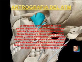 La artrografía con contraste de la ATM
permite diagnosticar las anomalías del disco
articular, la pequeña placa ovoide de tejido
fibrocartilaginoso o fibroso situada entre el
cóndilo y la fosa mandibulares. Las anomalías
de este disco pueden deberse a traumatismos o
a una distensión o aflojamiento del ligamento
posterior, que permite el desplazamiento anterior
del disco, con el consiguiente dolor.
 