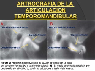 Figura 2: Artrografía postinyección de la ATM obtenida con la boca
del paciente cerrada (A) y totalmente abierta (B) . El medio de contraste positivo por
delante del cóndilo (flecha) confirma la luxación anterior del menisco.
A B
Conducto Auditivo Externo Conducto Auditivo Externo
Cápsula Articular Cápsula Articular
Cóndilo Mandibular Cóndilo Mandibular
 
