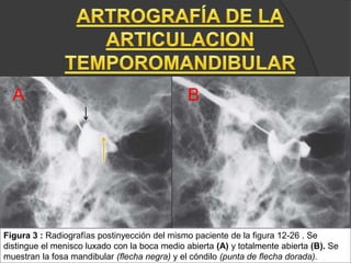 Figura 3 : Radiografías postinyección del mismo paciente de la figura 12-26 . Se
distingue el menisco luxado con la boca medio abierta (A) y totalmente abierta (B). Se
muestran la fosa mandibular (flecha negra) y el cóndilo (punta de flecha dorada).
A B
 