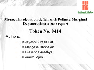 Monocular elevation deficit with Pellucid Marginal
Degeneration: A case report
Authors:
− Dr Jayesh Suresh Patil
− Dr Mangesh Dhobekar
− Dr Prasanna Aradhye
− Dr Amrita Ajani
Token No. 0414
 