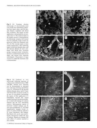 Fig. 5. (A) Scanning electron
microscopy of microvascular resin
casts of the liver immediately follow-
ing laser injury alone, and (B) ther-
mal ablation combined with blood
flow occlusion. The region of laser
application is demarcated by an avas-
cular zone (*). The extent of injury at
the margin (arrows) is heterogeneous
in both groups merging with normal
liver (L) sinusoids. Large vessels are
preserved within the treatment zone
(V). (C) The vascular injury is more
clearly demarcated 3 days following
injury in both laser therapy alone, and
(D) thermal ablation by laser com-
bined with blood flow occlusion
groups, varying in extent. A clear dis-
tinction is evident between the area of
injury and normal liver sinusoids
(arrowheads). Preservation of large
vessels (V) within the treatment zone
is demonstrated.
Fig. 6. (A) Confocal in vivo
microscopy following injection of
a fluorescein labelled dextran (MW
160 000). Normal liver sinusoids
can be demonstrated in untreated
liver with large draining interlobular
veins (V). Treatment by (B) thermal
ablation therapy alone, and (C) laser
with blood flow occlusion results in
an area of avascularity surrounding
the region of fibre application (*).
Immediately beyond this region
marked increased vascular permeabil-
ity is noted with leakage of contrast
material into the liver interstitium
(arrows). Heterogeneous regions of
increased contrast leakage can be
seen more peripherally (x). (D) High
magnification imaging reveals re-
gions of contrast build-up indicative
of vessel thrombosis and leakage.
Red blood cells can be seen (arrow-
heads) interspersed within the area
of leakage. Hepatocyte damage (H)
with influx of contrast material is
also evident.
THERMAL ABLATION WITH BLOOD FLOW OCCLUSION 89
Ó 2006 Royal Australasian College of Surgeons
 