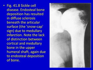 • Fig. 41.8 Sickle cell
disease. Endosteal bone
deposition has resulted
in diffuse sclerosis
beneath the articular
surface (the 'snow-cap'
sign) due to medullary
infarction. Note the lack
of distinction between
cortical and medullary
bone in the upper
humeral shaft, again due
to endosteal deposition
of bone.
 