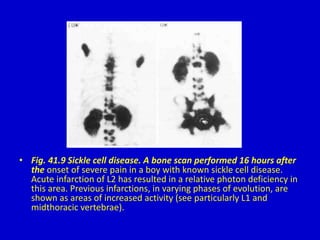 • Fig. 41.9 Sickle cell disease. A bone scan performed 16 hours after
the onset of severe pain in a boy with known sickle cell disease.
Acute infarction of L2 has resulted in a relative photon deficiency in
this area. Previous infarctions, in varying phases of evolution, are
shown as areas of increased activity (see particularly L1 and
midthoracic vertebrae).
 