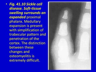 • Fig. 41.10 Sickle cell
disease. Soft-tissue
swelling surrounds an
expanded proximal
phalanx. Medullary
expansion is present
with simplification of
trabecular pattern and
penetration of the
cortex. The distinction
between these
changes and
osteomyelitis is
extremely difficult.
 