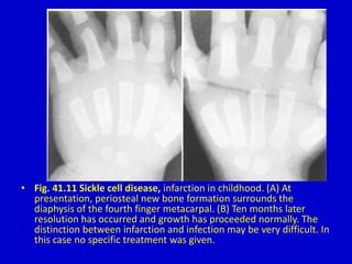 • Fig. 41.11 Sickle cell disease, infarction in childhood. (A) At
presentation, periosteal new bone formation surrounds the
diaphysis of the fourth finger metacarpal. (B) Ten months later
resolution has occurred and growth has proceeded normally. The
distinction between infarction and infection may be very difficult. In
this case no specific treatment was given.
 
