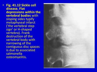 • Fig. 41.12 Sickle cell
disease. Flat
depressions within the
vertebral bodies with
sloping sides typify
metaphyseal infarct
('the vertebral step
sign' or H-shaped
vertebra). Frank
destruction of the
vertebral body with
narrowing of the
contiguous disc spaces
is due to associated
salmonella
osteomyelitis.
 