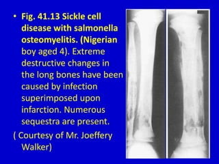 • Fig. 41.13 Sickle cell
disease with salmonella
osteomyelitis. (Nigerian
boy aged 4). Extreme
destructive changes in
the long bones have been
caused by infection
superimposed upon
infarction. Numerous
sequestra are present.
( Courtesy of Mr. Joeffery
Walker)
 