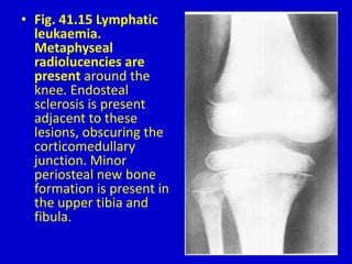 • Fig. 41.15 Lymphatic
leukaemia.
Metaphyseal
radiolucencies are
present around the
knee. Endosteal
sclerosis is present
adjacent to these
lesions, obscuring the
corticomedullary
junction. Minor
periosteal new bone
formation is present in
the upper tibia and
fibula.
 
