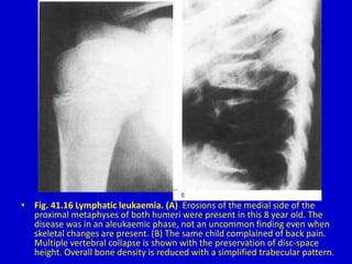 • Fig. 41.16 Lymphatic leukaemia. (A) Erosions of the medial side of the
proximal metaphyses of both humeri were present in this 8 year old. The
disease was in an aleukaemic phase, not an uncommon finding even when
skeletal changes are present. (B) The same child complained of back pain.
Multiple vertebral collapse is shown with the preservation of disc-space
height. Overall bone density is reduced with a simplified trabecular pattern.
 