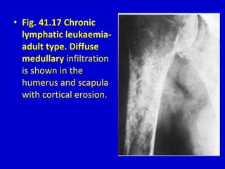 • Fig. 41.17 Chronic
lymphatic leukaemia-
adult type. Diffuse
medullary infiltration
is shown in the
humerus and scapula
with cortical erosion.
 