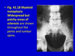 • Fig. 41.18 Myeloid
metaplasia
Widespread but
patchy areas of
sclerosis are shown
throughout the
pelvis and lumbar
spine.
 