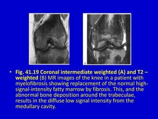 • Fig. 41.19 Coronal intermediate weighted (A) and T2 –
weighted (B) MR images of the knee in a patient with
myelofibrosis showing replacement of the normal high-
signal-intensity fatty marrow by fibrosis. This, and the
abnormal bone deposition around the trabeculae,
results in the diffuse low signal intensity from the
medullary cavity.
 