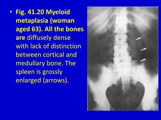 • Fig. 41.20 Myeloid
metaplasia (woman
aged 63). All the bones
are diffusely dense
with lack of distinction
between cortical and
medullary bone. The
spleen is grossly
enlarged (arrows).
 