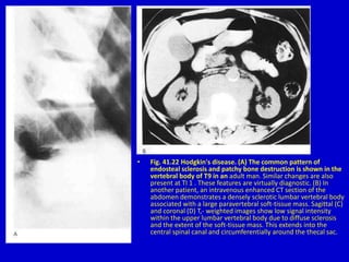 • Fig. 41.22 Hodgkin's disease. (A) The common pattern of
endosteal sclerosis and patchy bone destruction is shown in the
vertebral body of T9 in an adult man. Similar changes are also
present at TI 1 . These features are virtually diagnostic. (B) In
another patient, an intravenous enhanced CT section of the
abdomen demonstrates a densely sclerotic lumbar vertebral body
associated with a large paravertebral soft-tissue mass. Sagittal (C)
and coronal (D) T,- weighted images show low signal intensity
within the upper lumbar vertebral body due to diffuse sclerosis
and the extent of the soft-tissue mass. This extends into the
central spinal canal and circumferentially around the thecal sac.
 