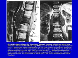 • Fig. 41.22 Hodgkin's disease. (A) The common pattern of endosteal sclerosis and patchy bone
destruction is shown in the vertebral body of T9 in an adult man. Similar changes are also present
at TI 1 . These features are virtually diagnostic. (B) In another patient, an intravenous enhanced CT
section of the abdomen demonstrates a densely sclerotic lumbar vertebral body associated with a
large paravertebral soft-tissue mass. Sagittal (C) and coronal (D) T,- weighted images show low
signal intensity within the upper lumbar vertebral body due to diffuse sclerosis and the extent of
the soft-tissue mass. This extends into the central spinal canal and circumferentially around the
thecal sac.
 