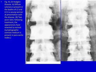 • Fig. 41.23 Hodgkin
Disease. A) Diffuse
sclerosis is present in
the bodies of L2 and
L3 in a young woman
at presentation with
the disease. (B) Two
years later, following
treatment, the
appearances have
reverted to normal.
(Lymphographic
contrast medium is
present in para-aortic
nodes.)
 