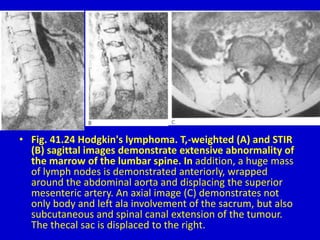 • Fig. 41.24 Hodgkin's lymphoma. T,-weighted (A) and STIR
(B) sagittal images demonstrate extensive abnormality of
the marrow of the lumbar spine. In addition, a huge mass
of lymph nodes is demonstrated anteriorly, wrapped
around the abdominal aorta and displacing the superior
mesenteric artery. An axial image (C) demonstrates not
only body and left ala involvement of the sacrum, but also
subcutaneous and spinal canal extension of the tumour.
The thecal sac is displaced to the right.
 