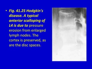 • Fig. 41.25 Hodgkin's
disease. A typical
anterior scalloping of
L4 is due to pressure
erosion from enlarged
lymph nodes. The
cortex is preserved, as
are the disc spaces.
 