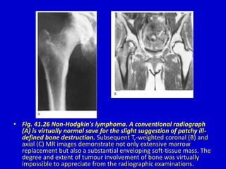 • Fig. 41.26 Non-Hodgkin's lymphoma. A conventional radiograph
(A) is virtually normal save for the slight suggestion of patchy ill-
defined bone destruction. Subsequent T,-weighted coronal (B) and
axial (C) MR images demonstrate not only extensive marrow
replacement but also a substantial enveloping soft-tissue mass. The
degree and extent of tumour involvement of bone was virtually
impossible to appreciate from the radiographic examinations.
 