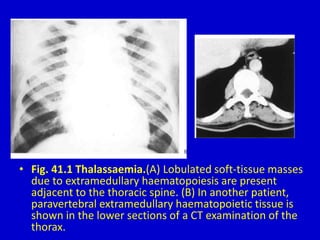 • Fig. 41.1 Thalassaemia.(A) Lobulated soft-tissue masses
due to extramedullary haematopoiesis are present
adjacent to the thoracic spine. (B) In another patient,
paravertebral extramedullary haematopoietic tissue is
shown in the lower sections of a CT examination of the
thorax.
 