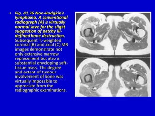 • Fig. 41.26 Non-Hodgkin's
lymphoma. A conventional
radiograph (A) is virtually
normal save for the slight
suggestion of patchy ill-
defined bone destruction.
Subsequent T,-weighted
coronal (B) and axial (C) MR
images demonstrate not
only extensive marrow
replacement but also a
substantial enveloping soft-
tissue mass. The degree
and extent of tumour
involvement of bone was
virtually impossible to
appreciate from the
radiographic examinations.
 