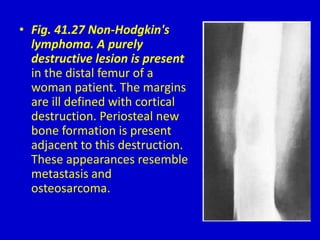 • Fig. 41.27 Non-Hodgkin's
lymphoma. A purely
destructive lesion is present
in the distal femur of a
woman patient. The margins
are ill defined with cortical
destruction. Periosteal new
bone formation is present
adjacent to this destruction.
These appearances resemble
metastasis and
osteosarcoma.
 