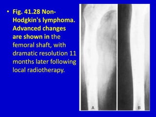 • Fig. 41.28 Non-
Hodgkin's lymphoma.
Advanced changes
are shown in the
femoral shaft, with
dramatic resolution 11
months later following
local radiotherapy.
 