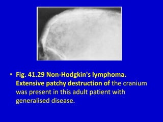 • Fig. 41.29 Non-Hodgkin's lymphoma.
Extensive patchy destruction of the cranium
was present in this adult patient with
generalised disease.
 