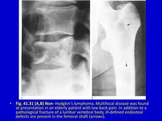 • Fig. 41.31 (A,B) Non- Hodgkin's lymphoma. Multifocal disease was found
at presentation in an elderly patient with low back pain. In addition to a
pathological fracture of a lumbar vertebral body, ill-defined endosteal
defects are present in the femoral shaft (arrows).
 