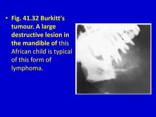 • Fig. 41.32 Burkitt's
tumour. A large
destructive lesion in
the mandible of this
African child is typical
of this form of
lymphoma.
 