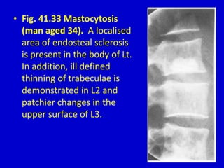• Fig. 41.33 Mastocytosis
(man aged 34). A localised
area of endosteal sclerosis
is present in the body of Lt.
In addition, ill defined
thinning of trabeculae is
demonstrated in L2 and
patchier changes in the
upper surface of L3.
 