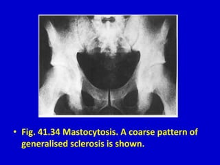 • Fig. 41.34 Mastocytosis. A coarse pattern of
generalised sclerosis is shown.
 