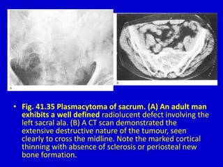 • Fig. 41.35 Plasmacytoma of sacrum. (A) An adult man
exhibits a well defined radiolucent defect involving the
left sacral ala. (B) A CT scan demonstrated the
extensive destructive nature of the tumour, seen
clearly to cross the midline. Note the marked cortical
thinning with absence of sclerosis or periosteal new
bone formation.
 