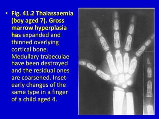 • Fig. 41.2 Thalassaemia
(boy aged 7). Gross
marrow hyperplasia
has expanded and
thinned overlying
cortical bone.
Medullary trabeculae
have been destroyed
and the residual ones
are coarsened. Inset-
early changes of the
same type in a finger
of a child aged 4.
 